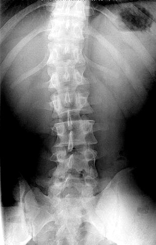 X-ray of the erect lumbar spine with a S-convex scoliosis